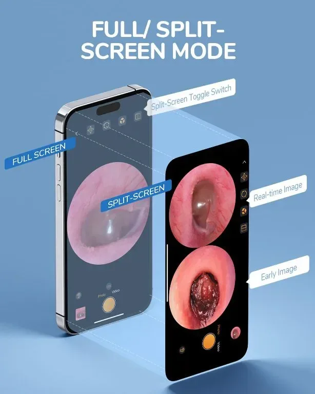 ScopeAround Камера за уши с отоскоп, за отстраняване на ушна кал, съвместим с iPhone 15/ Android — снимка 4